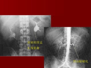 肾动脉硬化 肾动脉硬化 致密的肾盂 X 线影象 