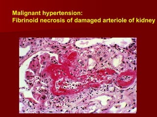 Malignant hypertension:  Fibrinoid necrosis of damaged arteriole of kidney 