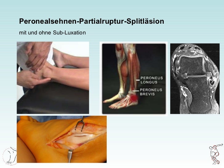 10 Jahre Therapie von Tendinosen