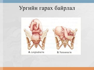 Ургийн гарах байрлал

 