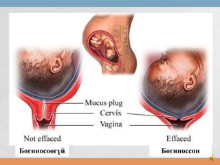 Богиносоогүй

Богиноссон

 