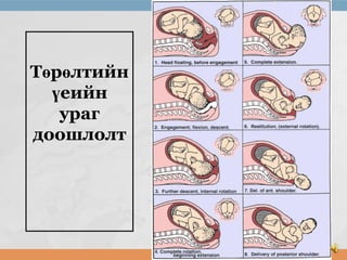 Төрөлтийн
үеийн
ураг
доошлолт

 