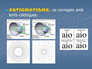  ASTIGMATISME: es corregeix amb
lents cilídriques.
 