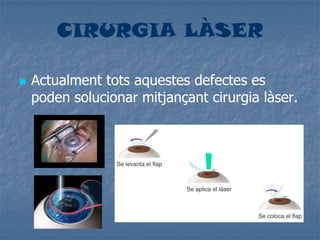 CIRURGIA LÀSER
 Actualment tots aquestes defectes es
poden solucionar mitjançant cirurgia làser.
 