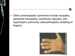 Other paraneoplastic syndromes include myopathy, peripheral neuropathy, acanthosis nigricans, and hypertrophic pulmonary osteoarthropathy (clubbing of fingers). 