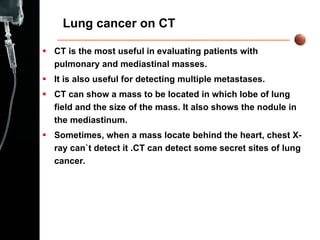 Lung cancer on CT  CT is the most useful in evaluating patients with pulmonary and mediastinal masses. It is also useful for detecting multiple metastases. CT can show a mass to be located in which lobe of lung field and the size of the mass. It also shows the nodule in the mediastinum. Sometimes, when a mass locate behind the heart, chest X-ray can`t detect it .CT can detect some secret sites of lung cancer.   