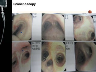 Bronchoscopy  