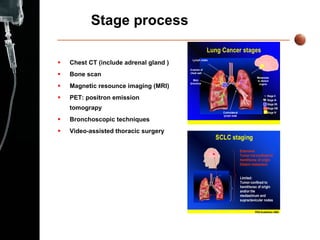 Stage process Chest CT (include adrenal gland ) Bone scan Magnetic resounce imaging (MRI)  PET: positron emission tomograpy Bronchoscopic techniques Video-assisted thoracic surgery 