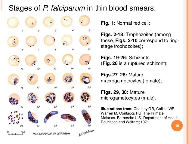 Malaria Parasite Ring Form Malaria Parasite Ring Form