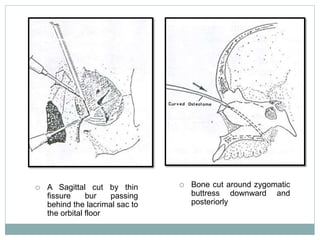  Bone cut around zygomatic
buttress downward and
posteriorly
 A Sagittal cut by thin
fissure bur passing
behind the lacrimal sac to
the orbital floor
 