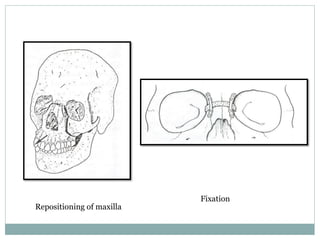 Repositioning of maxilla
Fixation
 