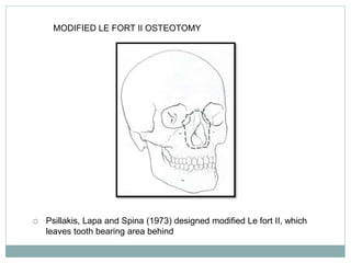 MODIFIED LE FORT II OSTEOTOMY
 Psillakis, Lapa and Spina (1973) designed modified Le fort II, which
leaves tooth bearing area behind
 