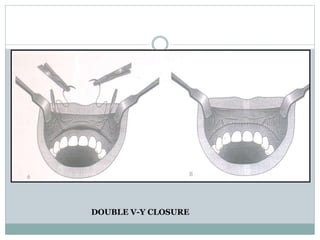 DOUBLE V-Y CLOSURE
 