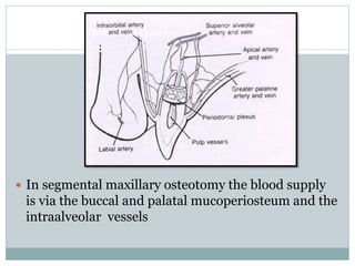  In segmental maxillary osteotomy the blood supply
is via the buccal and palatal mucoperiosteum and the
intraalveolar vessels
 
