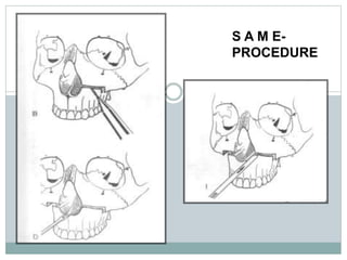 S A M E-
PROCEDURE
 
