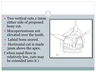  Two vertical cuts,1-2mm
either side of proposed
bony cut.
 Mucoperiosteum not
elevated over the tooth.
 Labial bone scored.
 Horizontal cut is made
3mm above the apex.
( when nasal floor is
relatively low, cuts may
be extended into it )
 