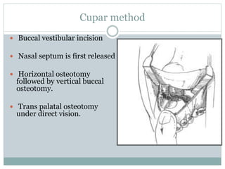 Cupar method
 Buccal vestibular incision
 Nasal septum is first released
 Horizontal osteotomy
followed by vertical buccal
osteotomy.
 Trans palatal osteotomy
under direct vision.
 