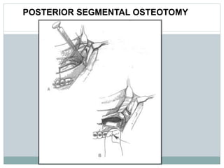 POSTERIOR SEGMENTAL OSTEOTOMY
 
