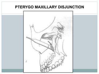 PTERYGO MAXILLARY DISJUNCTION
 
