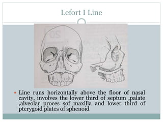 Lefort I Line
 Line runs horizontally above the floor of nasal
cavity, involves the lower third of septum ,palate
,alveolar proces sof maxilla and lower third of
pterygoid plates of sphenoid
 