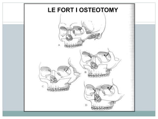 LE FORT I OSTEOTOMY
 