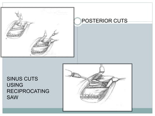 POSTERIOR CUTS
SINUS CUTS
USING
RECIPROCATING
SAW
 