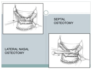 SEPTAL
OSTEOTOMY
LATERAL NASAL
OSTEOTOMY
 