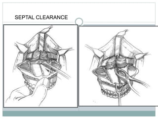 SEPTAL CLEARANCE
 