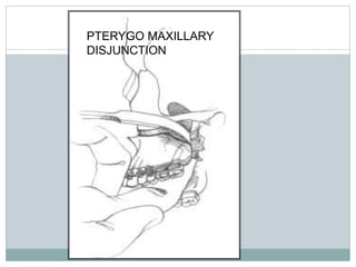 PTERYGO MAXILLARY
DISJUNCTION
 