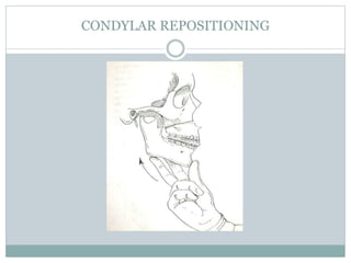 CONDYLAR REPOSITIONING
 