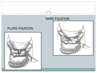 WIRE FIXATION
PLATE FIXATION
 