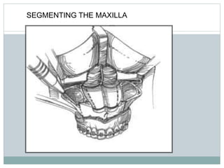 SEGMENTING THE MAXILLA
 