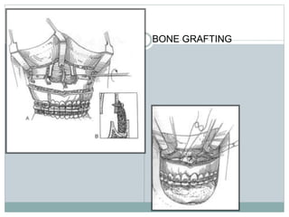 BONE GRAFTING
 