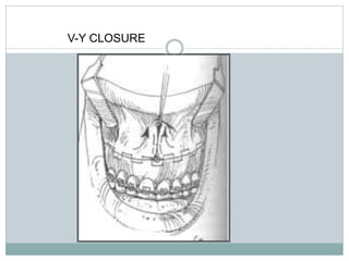 V-Y CLOSURE
 