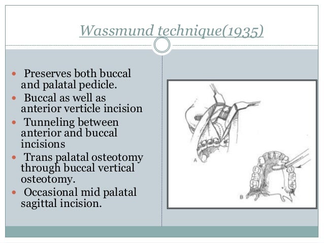 lefort osteotomies