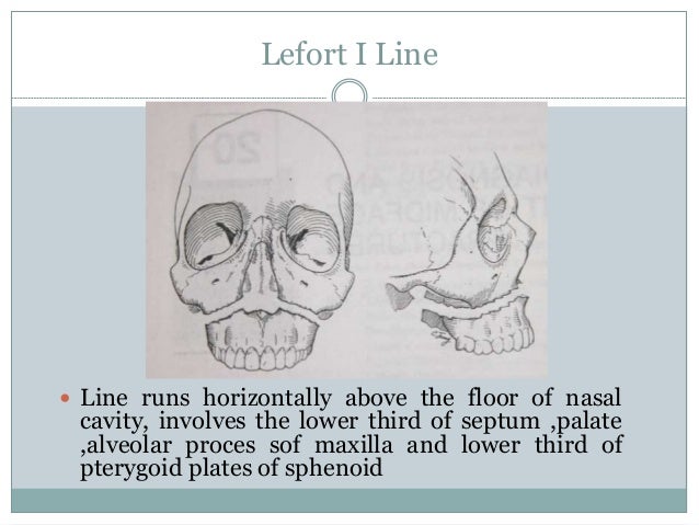 lefort osteotomies