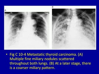 • Fig C 10-4 Metastatic thyroid carcinoma. (A)
Multiple fine miliary nodules scattered
throughout both lungs. (B) At a later stage, there
is a coarser miliary pattern.