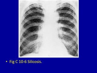 • Fig C 10-6 Silicosis.