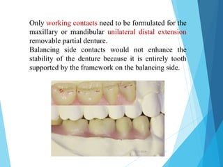 Unilaterl Rpds occlusion in rpds | PPTX