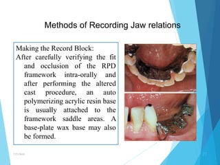 Occlusal Record Rpd occlusion in rpds | PPTX