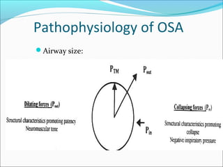 Pathophysiology of OSA
Airway size:
 