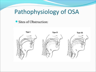 Pathophysiology of OSA
Sites of Obstruction:
 
