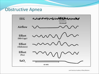 EEG
10 sec
Arousal
Airflow
Effort
(Pes)
SaO2
Effort
(Abdomen)
Effort
(Rib Cage)
2006 American Academy of Sleep Medicine
 