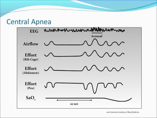 10 sec
Arousal
EEG
Airflow
Effort
(Pes)
SaO2
Effort
(Abdomen)
Effort
(Rib Cage)
2006 American Academy of Sleep Medicine
 