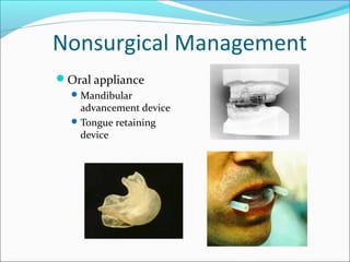 Nonsurgical Management
Oral appliance
Mandibular
advancement device
Tongue retaining
device
 