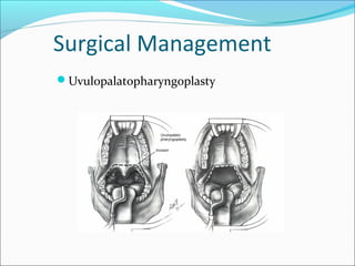 Surgical Management
Uvulopalatopharyngoplasty
 