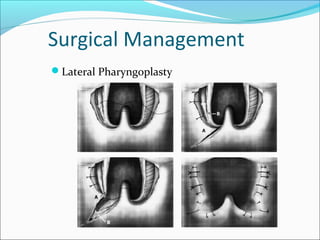 Surgical Management
Lateral Pharyngoplasty
 
