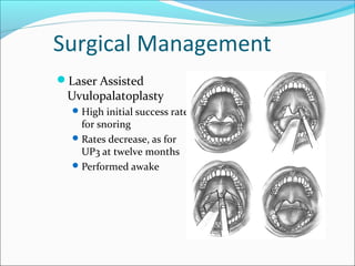 Surgical Management
Laser Assisted
Uvulopalatoplasty
High initial success rate
for snoring
Rates decrease, as for
UP3 at twelve months
Performed awake
 