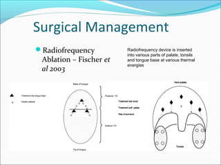 Surgical Management
Radiofrequency
Ablation – Fischer et
al 2003
Radiofrequency device is inserted
into various parts of palate, tonsils
and tongue base at various thermal
energies
 