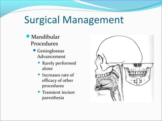 Surgical Management
Mandibular
Procedures
Genioglossus
Advancement
 Rarely performed
alone
 Increases rate of
efficacy of other
procedures
 Transient incisor
paresthesia
 